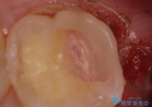 奥の虫歯 ジルコニアクラウンでの修復の治療中