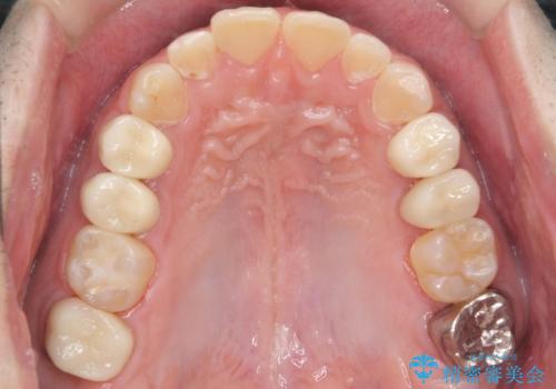 できる限り口の中を綺麗にしたい。の症例 治療後