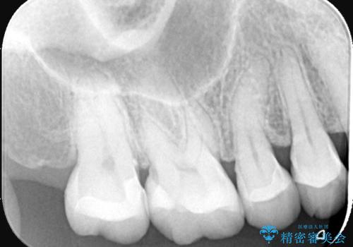 【セラミックインレー】むし歯の再発防止を考えた治療の治療後