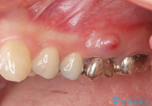 虫歯・破折の放置により重度に吸収した歯槽骨 骨造成後のインプラント治療の症例 治療前