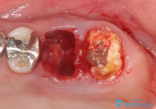 虫歯・破折の放置により重度に吸収した歯槽骨　骨造成後のインプラント治療の治療前