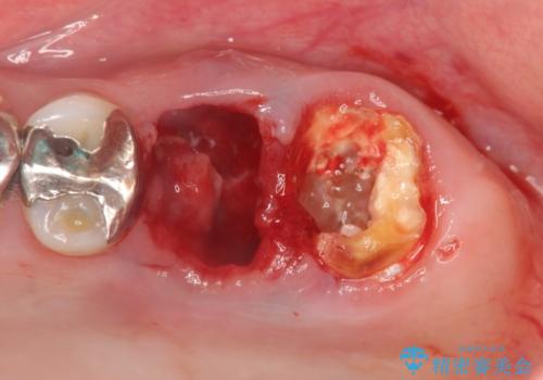 虫歯・破折の放置により重度に吸収した歯槽骨 骨造成後のインプラント治療の治療前