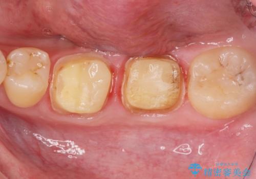 [ 歯の破折 ] 取れない違和感 歯の破折をインプラント治療で改善の治療中