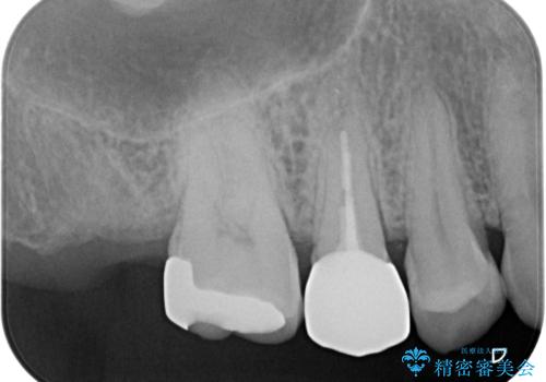 【オールセラミッククラウン】根管治療も行いたい。の治療前