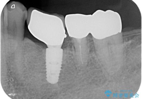 【1Dayインプラント治療! 低侵襲で短期間での治療】 咬むと歯が痛い! 歯根破折の治療前