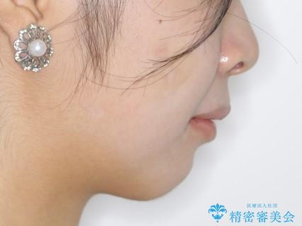 前歯のがたつきとディープバイト:インビザライン治療の治療前(顔貌)