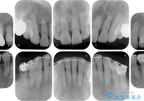 治療中で放置 インプラントでしっかりと咬めるようにの治療前