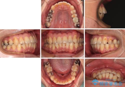 銀歯をなくしたい　全顎的なむし歯治療の治療前