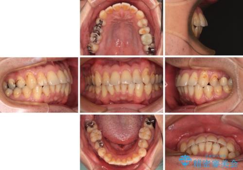 銀歯をなくしたい 全顎的なむし歯治療の治療前