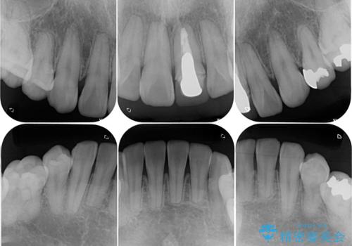 薬剤の影響で変色した歯を自然に　オールセラミッククラウンによる審美歯科治療の治療前