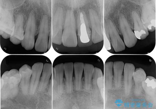 薬剤の影響で変色した歯を自然に オールセラミッククラウンによる審美歯科治療の治療前