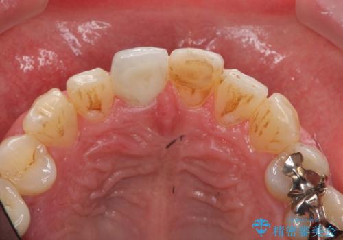 前歯の変色を改善　オールセラミック治療の治療後
