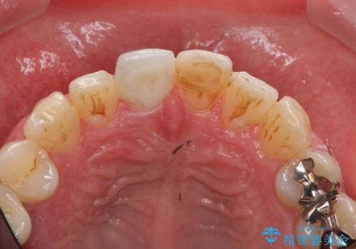 前歯の変色を改善 オールセラミック治療の治療後