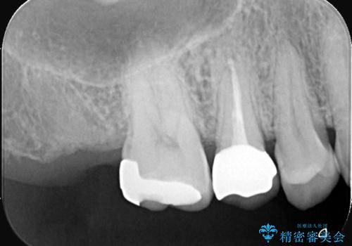 【オールセラミッククラウン】根管治療も行いたい。の治療後