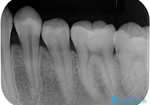 矯正前の虫歯治療の治療後