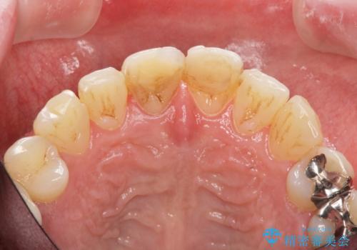 前歯の変色を改善　オールセラミック治療の治療前
