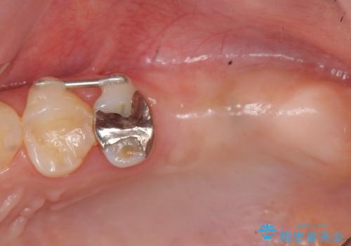 虫歯・破折の放置により重度に吸収した歯槽骨 骨造成後のインプラント治療の治療中
