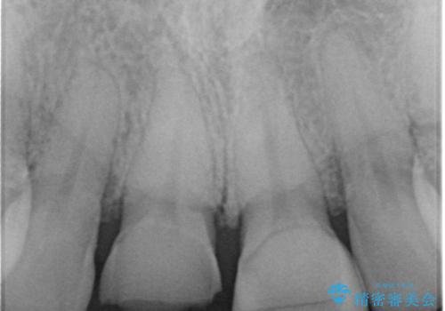 ラミネートべニアが取れた ジルコニアクラウンでの修復の治療前