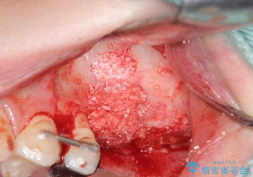 虫歯・破折の放置により重度に吸収した歯槽骨　骨造成後のインプラント治療の治療中
