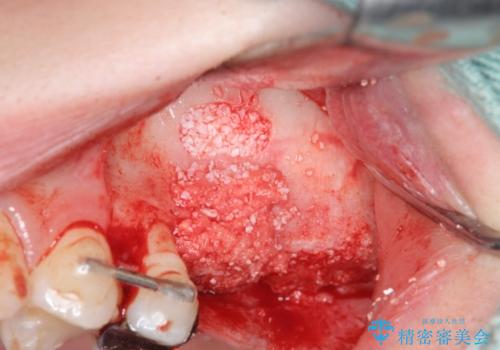 虫歯・破折の放置により重度に吸収した歯槽骨 骨造成後のインプラント治療の治療中