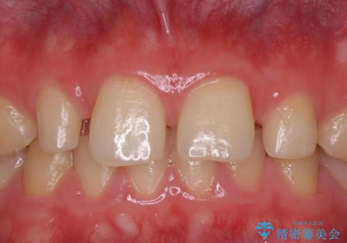前歯の隙間を埋めたい　矯正かクラウンか