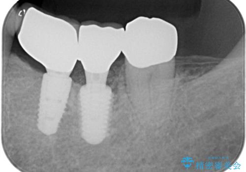 【1Dayインプラント治療! 低侵襲で短期間での治療】 咬むと歯が痛い! 歯根破折の治療後