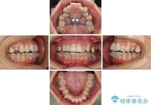 急速拡大装置　狭い歯列を拡大してワイヤー装置で短期間治療の治療中