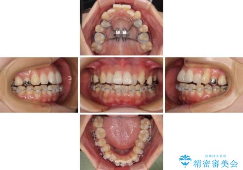 急速拡大装置 狭い歯列を拡大してワイヤー装置で短期間治療の治療中