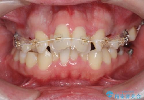 [突き出た前歯を引っ込めたい] ワイヤー矯正とマウスピース矯正の併用治療の治療前