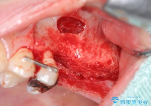 虫歯・破折の放置により重度に吸収した歯槽骨 骨造成後のインプラント治療の治療中