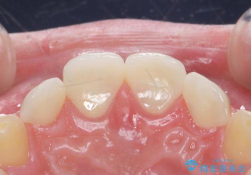 前歯の隙間を埋めたい　矯正かクラウンかの治療後