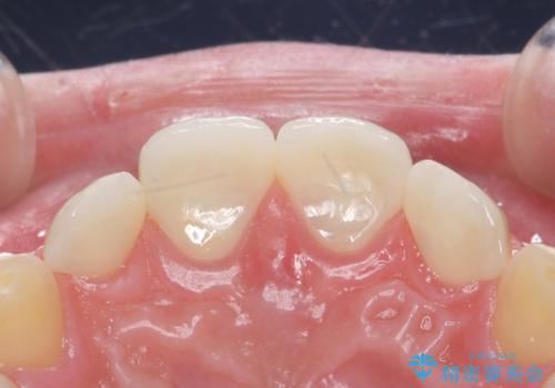 前歯の隙間を埋めたい 矯正かクラウンかの治療後