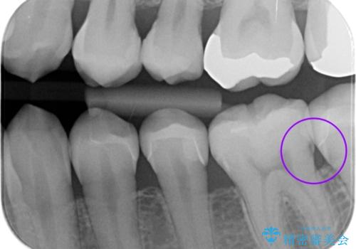 詰め物の治療。の治療前