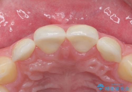 前歯の隙間を埋めたい　矯正かクラウンかの治療後