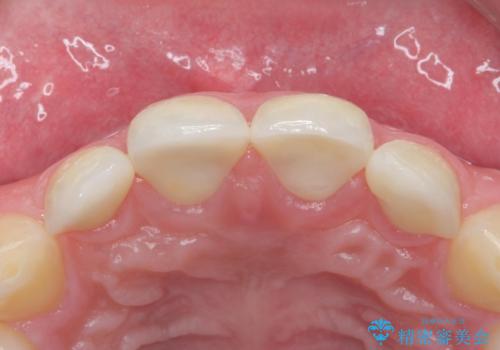前歯の隙間を埋めたい 矯正かクラウンかの治療後