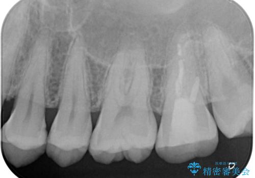左上がしみて痛い　セラミックインレー修復の治療前