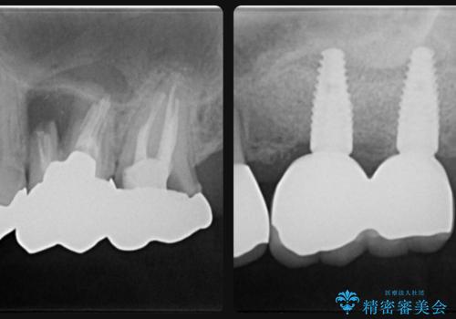 虫歯・破折の放置により重度に吸収した歯槽骨　骨造成後のインプラント治療
