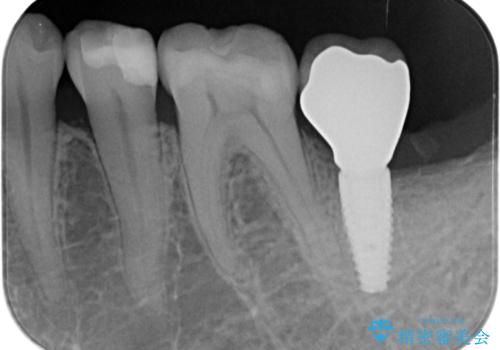 歯からの異臭　虫歯の再発からのインプラント治療