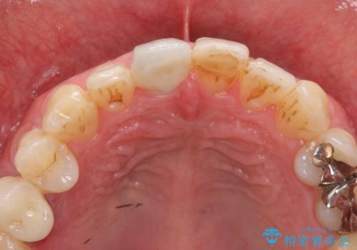 前歯の変色を改善　オールセラミック治療の治療後