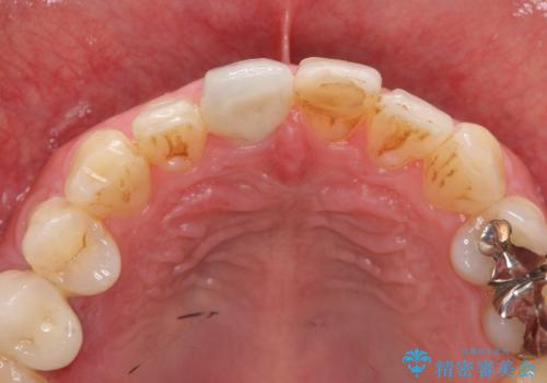 前歯の変色を改善 オールセラミック治療の治療後