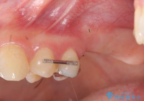 虫歯・破折の放置により重度に吸収した歯槽骨 骨造成後のインプラント治療の治療中