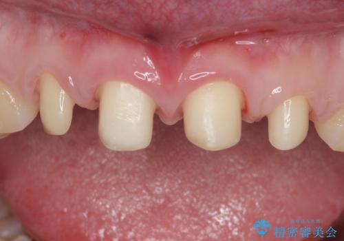 前歯の隙間を埋めたい 矯正かクラウンかの治療中