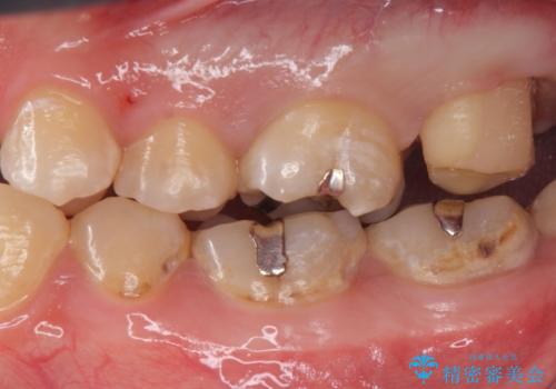 奥の虫歯 ジルコニアクラウンでの修復の治療中