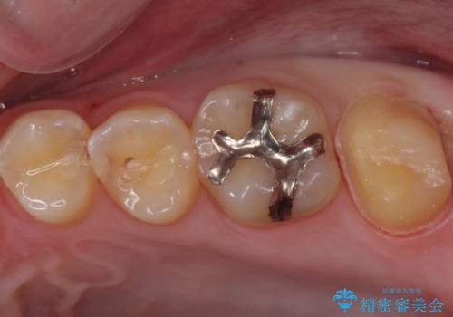 奥の虫歯 ジルコニアクラウンでの修復の治療中