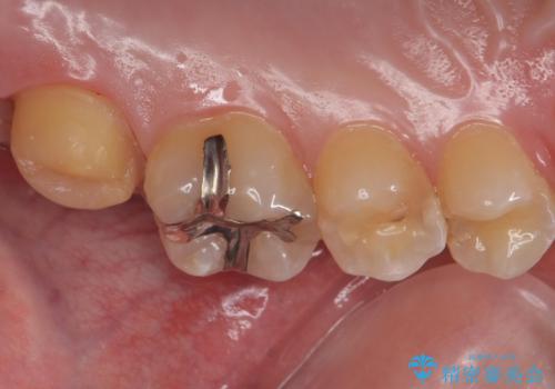 奥の虫歯 ジルコニアクラウンでの修復の治療中