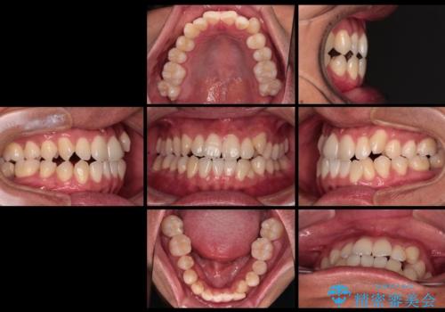 急速拡大装置 歯列弓を拡大して非抜歯ワイヤー矯正の治療前