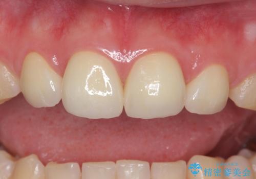 前歯の隙間を埋めたい 矯正かクラウンかの治療後