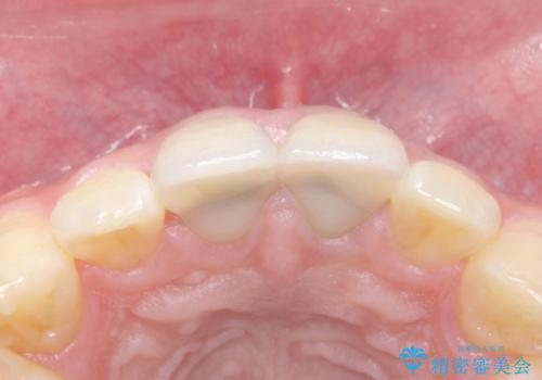 前歯を綺麗にしたい e-maxクラウンでの修復の治療後