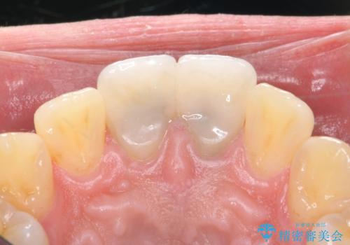 前歯を綺麗にしたい e-maxクラウンでの修復の治療後