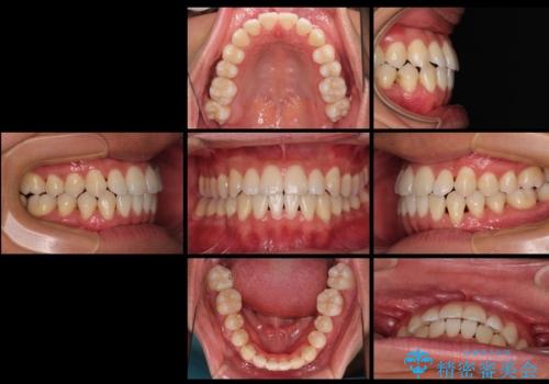 急速拡大装置 歯列弓を拡大して非抜歯ワイヤー矯正の治療後
